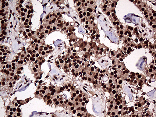 ZRANB2 / ZNF265 Antibody - Immunohistochemical staining of paraffin-embedded Carcinoma of Human pancreas tissue using anti-ZRANB2 mouse monoclonal antibody. (Heat-induced epitope retrieval by 1mM EDTA in 10mM Tris buffer. (pH8.5) at 120°C for 3 min. (1:2000)