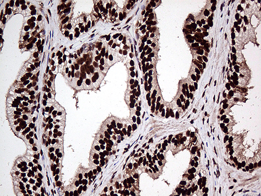 ZRANB2 / ZNF265 Antibody - Immunohistochemical staining of paraffin-embedded Carcinoma of Human prostate tissue using anti-ZRANB2 mouse monoclonal antibody. (Heat-induced epitope retrieval by 1mM EDTA in 10mM Tris buffer. (pH8.5) at 120°C for 3 min. (1:2000)