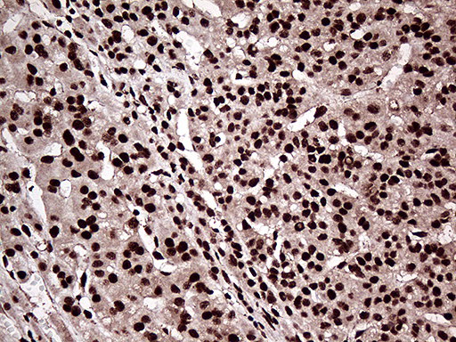 ZRANB2 / ZNF265 Antibody - Immunohistochemical staining of paraffin-embedded Carcinoma of Human liver tissue using anti-ZRANB2 mouse monoclonal antibody. (Heat-induced epitope retrieval by 1mM EDTA in 10mM Tris buffer. (pH8.5) at 120°C for 3 min. (1:2000)
