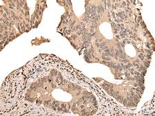 ZSCAN12 Antibody - Immunohistochemistry of paraffin-embedded Human colorectal cancer tissue  using ZSCAN12 Polyclonal Antibody at dilution of 1:50(×200)