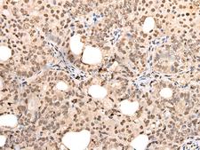 ZSCAN12 Antibody - Immunohistochemistry of paraffin-embedded Human ovarian cancer tissue  using ZSCAN12 Polyclonal Antibody at dilution of 1:40(×200)
