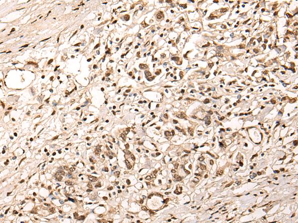 ZSCAN12 Antibody - Immunohistochemistry of paraffin-embedded Human gastric cancer tissue  using ZSCAN12 Polyclonal Antibody at dilution of 1:40(×200)