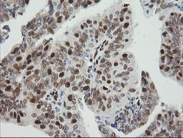 ZSCAN18 / ZNF447 Antibody - IHC of paraffin-embedded Adenocarcinoma of Human endometrium tissue using anti-ZSCAN18 mouse monoclonal antibody.