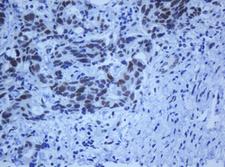 ZSCAN18 / ZNF447 Antibody - IHC of paraffin-embedded Adenocarcinoma of Human breast tissue using anti-ZSCAN18 mouse monoclonal antibody.