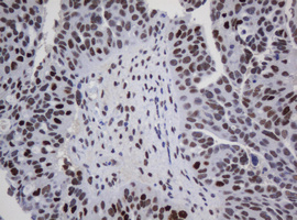 ZSCAN18 / ZNF447 Antibody - IHC of paraffin-embedded Adenocarcinoma of Human ovary tissue using anti-ZSCAN18 mouse monoclonal antibody.