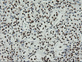 ZSCAN18 / ZNF447 Antibody - IHC of paraffin-embedded Carcinoma of Human kidney tissue using anti-ZSCAN18 mouse monoclonal antibody.
