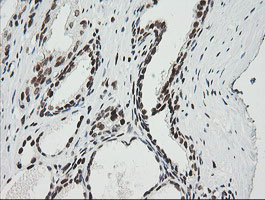 ZSCAN18 / ZNF447 Antibody - IHC of paraffin-embedded Carcinoma of Human prostate tissue using anti-ZSCAN18 mouse monoclonal antibody.