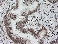 ZSCAN18 / ZNF447 Antibody - IHC of paraffin-embedded Adenocarcinoma of Human colon tissue using anti-ZSCAN18 mouse monoclonal antibody.
