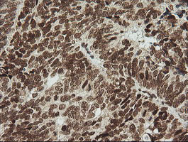 ZSCAN18 / ZNF447 Antibody - IHC of paraffin-embedded Adenocarcinoma of Human ovary tissue using anti-ZSCAN18 mouse monoclonal antibody.