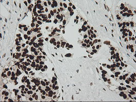 ZSCAN18 / ZNF447 Antibody - IHC of paraffin-embedded Carcinoma of Human pancreas tissue using anti-ZSCAN18 mouse monoclonal antibody.