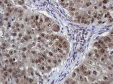 ZSCAN18 / ZNF447 Antibody - IHC of paraffin-embedded Adenocarcinoma of Human colon tissue using anti-ZSCAN18 mouse monoclonal antibody.