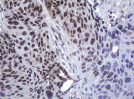 ZSCAN18 / ZNF447 Antibody - IHC of paraffin-embedded Carcinoma of Human lung tissue using anti-ZSCAN18 mouse monoclonal antibody.