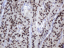 ZSCAN18 / ZNF447 Antibody - IHC of paraffin-embedded Carcinoma of Human thyroid tissue using anti-ZSCAN18 mouse monoclonal antibody.