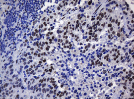 ZSCAN18 / ZNF447 Antibody - IHC of paraffin-embedded Carcinoma of Human lung tissue using anti-ZSCAN18 mouse monoclonal antibody.