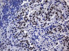 ZSCAN18 / ZNF447 Antibody - IHC of paraffin-embedded Carcinoma of Human lung tissue using anti-ZSCAN18 mouse monoclonal antibody.