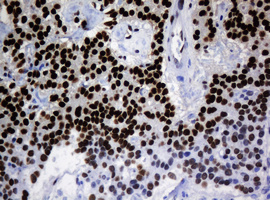 ZSCAN18 / ZNF447 Antibody - IHC of paraffin-embedded Carcinoma of Human pancreas tissue using anti-ZSCAN18 mouse monoclonal antibody.