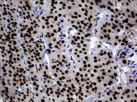 ZSCAN18 / ZNF447 Antibody - IHC of paraffin-embedded Carcinoma of Human thyroid tissue using anti-ZSCAN18 mouse monoclonal antibody.