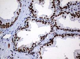 ZSCAN18 / ZNF447 Antibody - IHC of paraffin-embedded Carcinoma of Human prostate tissue using anti-ZSCAN18 mouse monoclonal antibody.