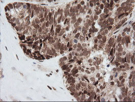 ZSCAN18 / ZNF447 Antibody - IHC of paraffin-embedded Adenocarcinoma of Human ovary tissue using anti-ZSCAN18 mouse monoclonal antibody. (Heat-induced epitope retrieval by 10mM citric buffer, pH6.0, 120°C for 3min).