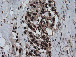 ZSCAN18 / ZNF447 Antibody - IHC of paraffin-embedded Carcinoma of Human pancreas tissue using anti-ZSCAN18 mouse monoclonal antibody. (Heat-induced epitope retrieval by 10mM citric buffer, pH6.0, 120°C for 3min).
