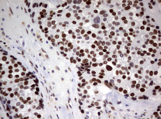 ZSCAN18 / ZNF447 Antibody - Immunohistochemical staining of paraffin-embedded Adenocarcinoma of Human breast tissue using anti-ZSCAN18 mouse monoclonal antibody.  heat-induced epitope retrieval by 10mM citric buffer, pH6.0, 120C for 3min)