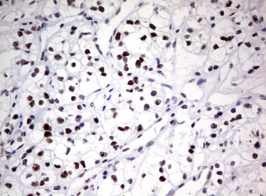 ZSCAN18 / ZNF447 Antibody - Immunohistochemical staining of paraffin-embedded Carcinoma of Human kidney tissue using anti-ZSCAN18 mouse monoclonal antibody.  heat-induced epitope retrieval by 10mM citric buffer, pH6.0, 120C for 3min)