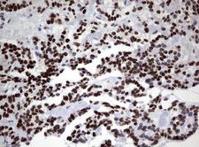 ZSCAN18 / ZNF447 Antibody - Immunohistochemical staining of paraffin-embedded Carcinoma of Human pancreas tissue using anti-ZSCAN18 mouse monoclonal antibody.  heat-induced epitope retrieval by 10mM citric buffer, pH6.0, 120C for 3min)