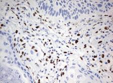 ZSCAN18 / ZNF447 Antibody - Immunohistochemical staining of paraffin-embedded Carcinoma of Human lung tissue using anti-ZSCAN18mouse monoclonal antibody.  heat-induced epitope retrieval by 10mM citric buffer, pH6.0, 120C for 3min)