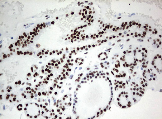 ZSCAN18 / ZNF447 Antibody - Immunohistochemical staining of paraffin-embedded Carcinoma of Human thyroid tissue using anti-ZSCAN18 mouse monoclonal antibody.  heat-induced epitope retrieval by 10mM citric buffer, pH6.0, 120C for 3min)