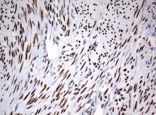 ZSCAN18 / ZNF447 Antibody - Immunohistochemical staining of paraffin-embedded Human endometrium tissue using anti-ZSCAN18 mouse monoclonal antibody.  heat-induced epitope retrieval by 10mM citric buffer, pH6.0, 120C for 3min)