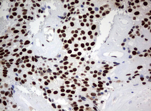 ZSCAN18 / ZNF447 Antibody - Immunohistochemical staining of paraffin-embedded Adenocarcinoma of Human breast tissue using anti-ZSCAN18 mouse monoclonal antibody.  heat-induced epitope retrieval by 10mM citric buffer, pH6.0, 120C for 3min)