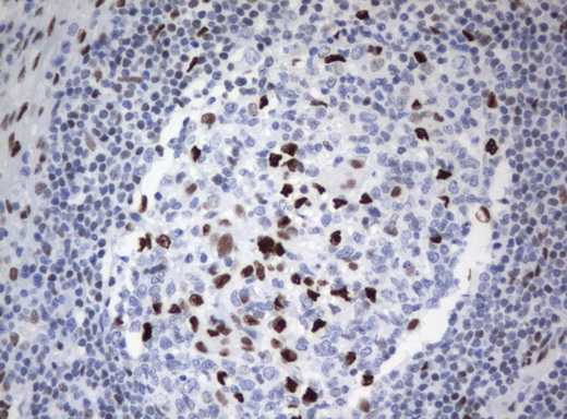 ZSCAN18 / ZNF447 Antibody - Immunohistochemical staining of paraffin-embedded Carcinoma of Human bladder tissue using anti-ZSCAN18 mouse monoclonal antibody.  heat-induced epitope retrieval by 10mM citric buffer, pH6.0, 120C for 3min)