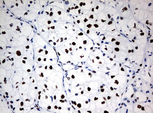 ZSCAN18 / ZNF447 Antibody - Immunohistochemical staining of paraffin-embedded Carcinoma of Human kidney tissue using anti-ZSCAN18 mouse monoclonal antibody.  heat-induced epitope retrieval by 10mM citric buffer, pH6.0, 120C for 3min)