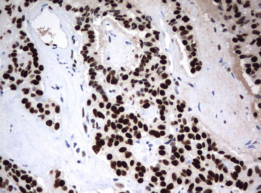 ZSCAN18 / ZNF447 Antibody - Immunohistochemical staining of paraffin-embedded Carcinoma of Human pancreas tissue using anti-ZSCAN18 mouse monoclonal antibody.  heat-induced epitope retrieval by 10mM citric buffer, pH6.0, 120C for 3min)