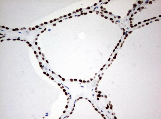 ZSCAN18 / ZNF447 Antibody - Immunohistochemical staining of paraffin-embedded Human thyroid tissue using anti-ZSCAN18 mouse monoclonal antibody.  heat-induced epitope retrieval by 10mM citric buffer, pH6.0, 120C for 3min)