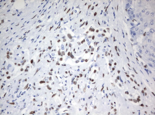 ZSCAN18 / ZNF447 Antibody - Immunohistochemical staining of paraffin-embedded Carcinoma of Human liver tissue using anti-ZSCAN18 mouse monoclonal antibody.  heat-induced epitope retrieval by 10mM citric buffer, pH6.0, 120C for 3min)