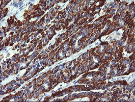 ZSCAN21 / Zipro1 Antibody - IHC of paraffin-embedded Carcinoma of Human thyroid tissue using anti-ZSCAN21 mouse monoclonal antibody.