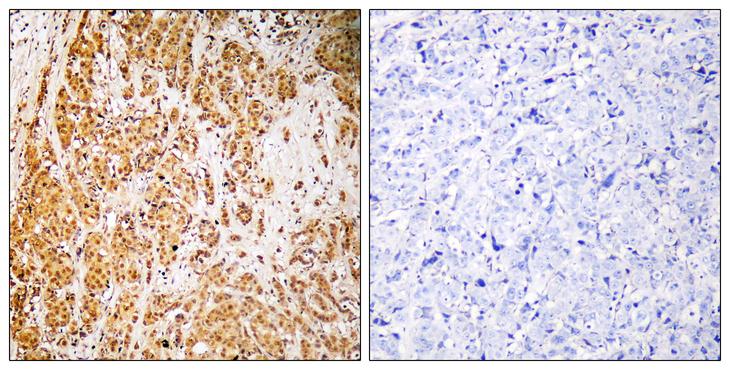 ZSCAN22 Antibody - Peptide - + Immunohistochemistry analysis of paraffin-embedded human breast carcinoma tissue, using ZSCAN22 antibody.