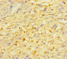 ZSCAN29 Antibody - Immunohistochemistry of paraffin-embedded human melanoma using ZSCAN29 Antibody at dilution of 1:100