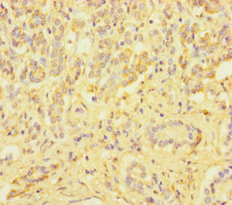 ZSCAN29 Antibody - Immunohistochemistry of paraffin-embedded human pancreatic cancer using ZSCAN29 Antibody at dilution of 1:100