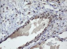 ZSCAN4 Antibody - IHC of paraffin-embedded Adenocarcinoma of Human ovary tissue using anti-ZSCAN4 mouse monoclonal antibody.
