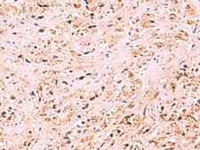 ZSWIM1 Antibody - Immunohistochemistry of paraffin-embedded Human prost at e cancer tissue  using ZSWIM1 Polyclonal Antibody at dilution of 1:95(×200)
