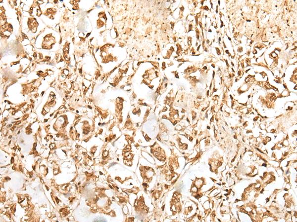 ZUFSP Antibody - Immunohistochemistry of paraffin-embedded Human gastric cancer tissue  using ZUFSP Polyclonal Antibody at dilution of 1:35(×200)