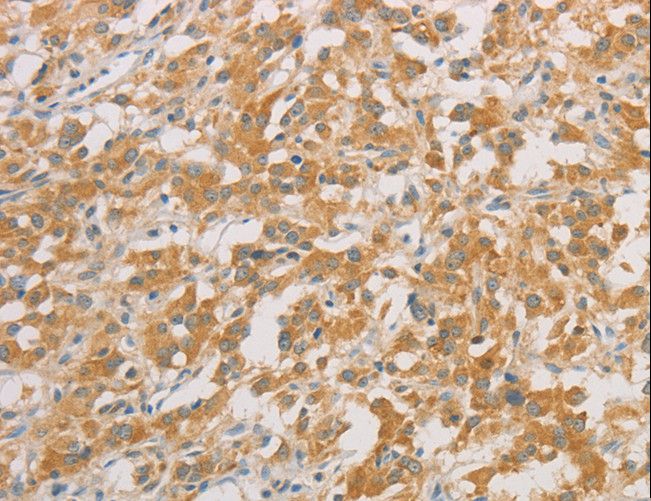 ZWINT Antibody - Immunohistochemistry of paraffin-embedded Human colon cancer using ZWINT Polyclonal Antibody at dilution of 1:50.