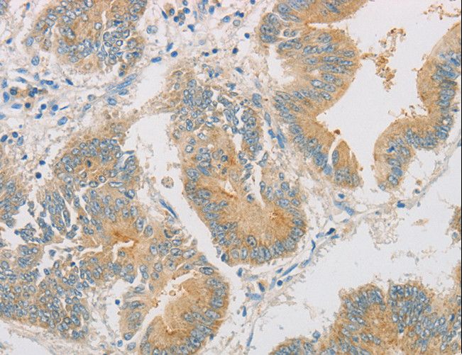 ZWINT Antibody - Immunohistochemistry of paraffin-embedded Human colon cancer using ZWINT Polyclonal Antibody at dilution of 1:50.