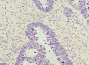 ZWINT Antibody - Immunohistochemistry of paraffin-embedded human ovarian cancer at dilution 1:100